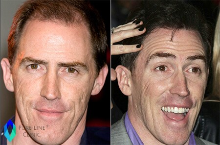 Rob Brydon Hair Transplant Before After